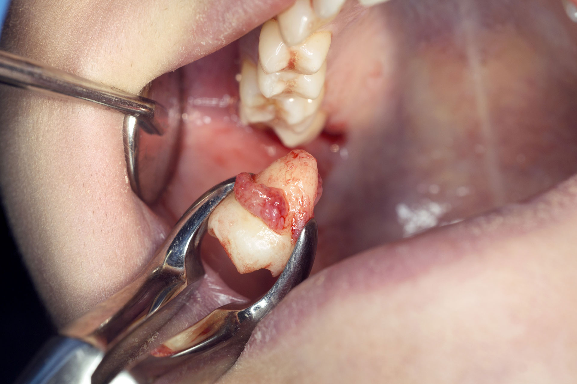 고난도사랑니발치 이미지