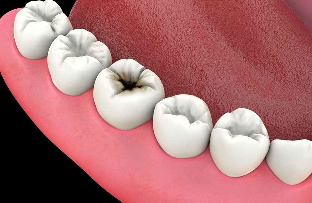 충치치료 이미지